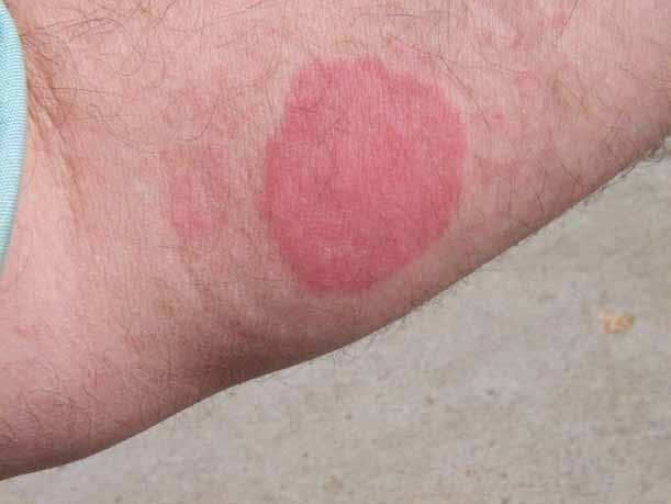 Allergic Reaction To Mosquito Bites | New Health Advisor